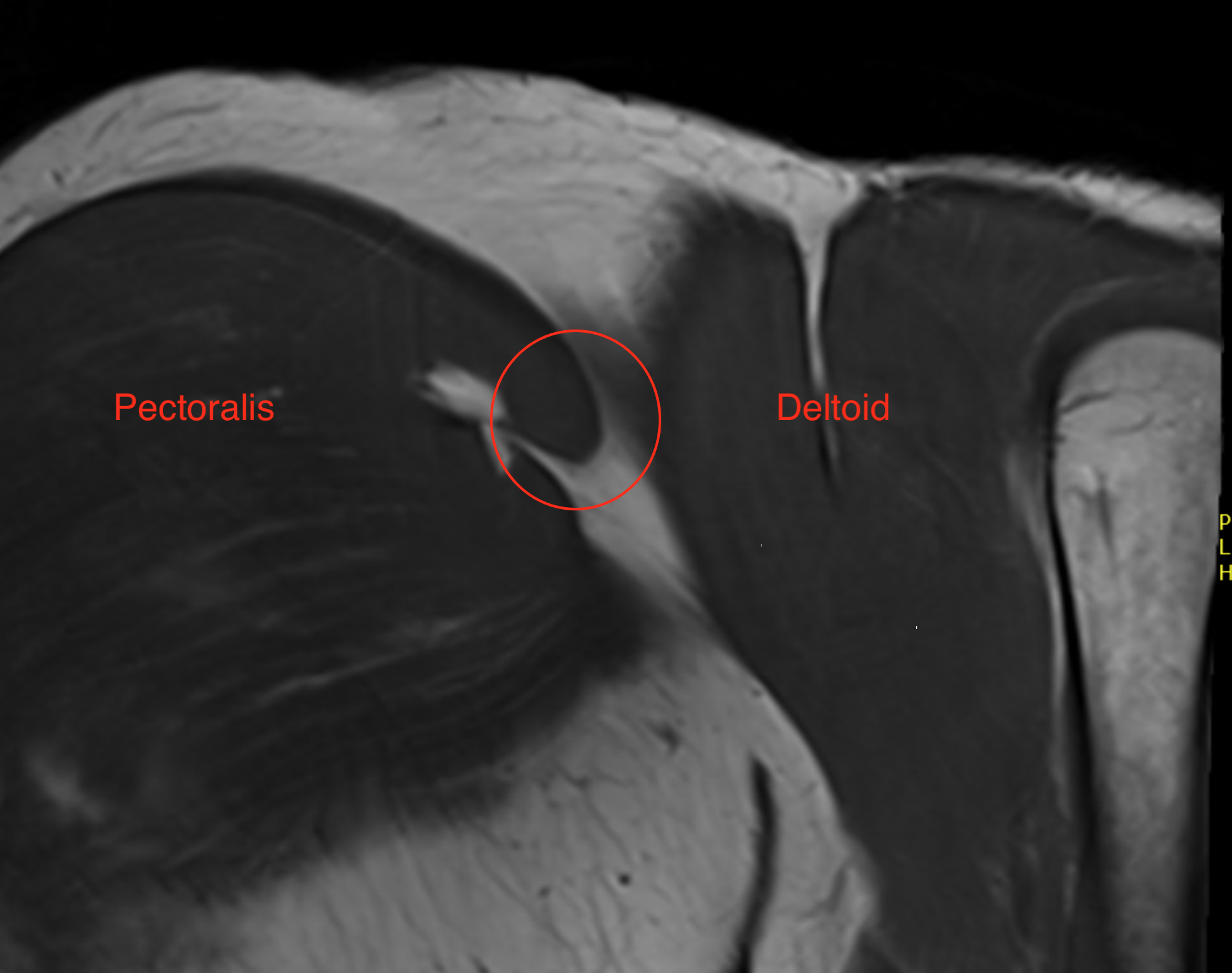 Chronic Pectoralis Major 1